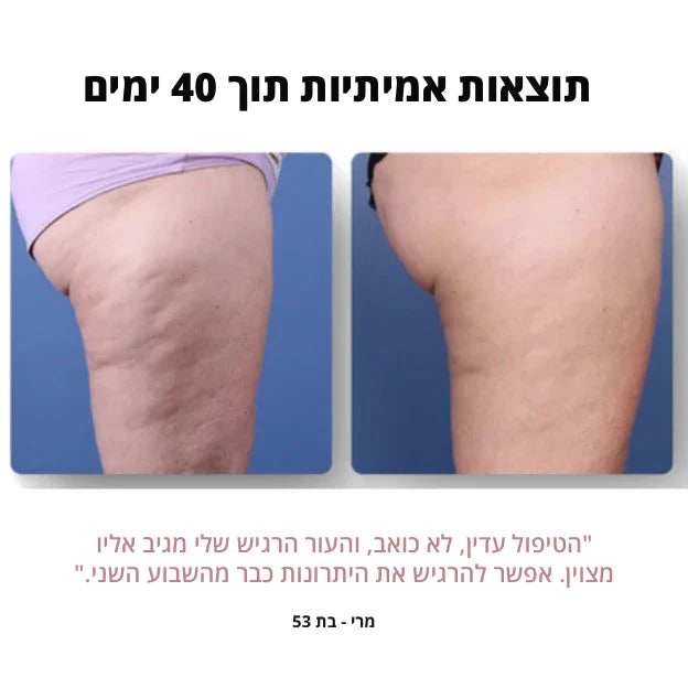 מסאג'ר אנטי-צלוליט